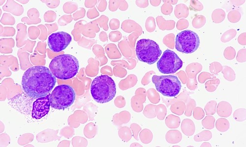 Image credit: "Acute Promyelocytic Leukemia, Marrow Aspirate" by euthman, CC BY 2.0.
